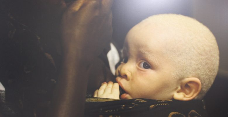 ‘Kara Kıtanın Beyaz Çocukları’: Afrikalı albinoların dramı sanatseverlerle buluştu